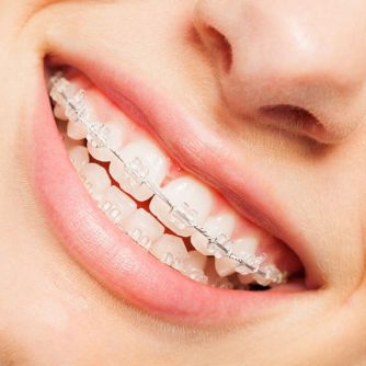 Invisible Aligners